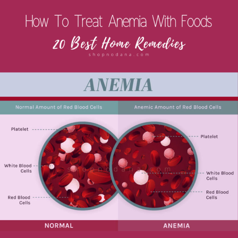 How To Treat Anemia With Foods- 20 Best Home Remedies - Shopno Dana