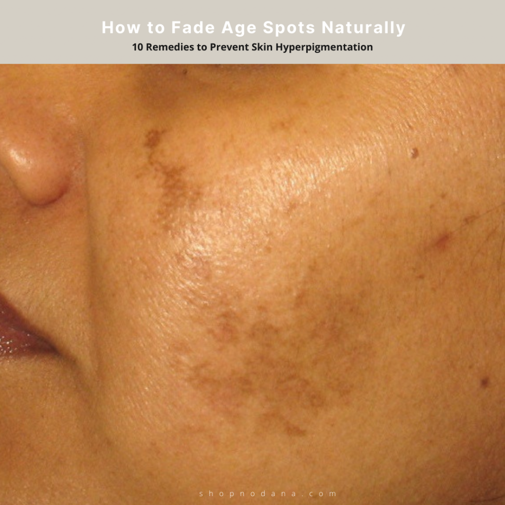 how-to-fade-age-spots-naturally-10-remedies-to-prevent-skin